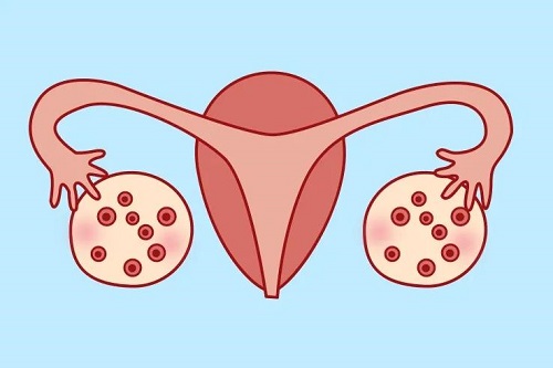 多囊卵巢与熬夜有关吗？双卵巢多囊综合症要多少钱调理？