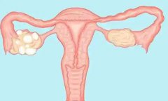 多囊和输卵管有关系吗？多囊卵巢综合症与输卵管堵塞有关系吗？